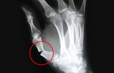 compound-fractures-x-ray Ulna Bone, Scaphoid Fracture, Radius Bone, Heal Broken Bones, Ortho Nurse, Types Of Fractures, Radius And Ulna, Fracture Healing, Outstretched Hand