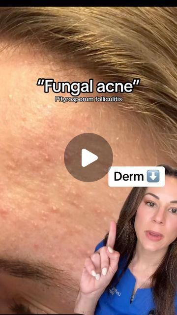 Fungal Acne Skin Care Routine, Bacterial Acne, Pustules Acne, Comedonal Acne, Treating Cystic Acne, Back Acne Remedies, Cystic Acne Remedies, Different Types Of Acne, Deep Clean Skin