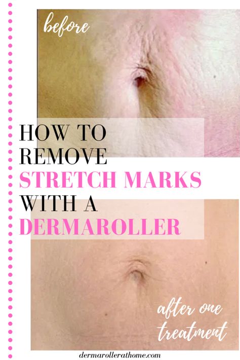 Stretch Mark Removal Before And After, Mom Belly Before And After, Dermapen Before And After, Dermarolling Before And After, Dermarolling Stomach, Dermaroller Before And After, Micro Needling Before And After, Stretch Mark Microneedling, Dermarolling Loose Skin