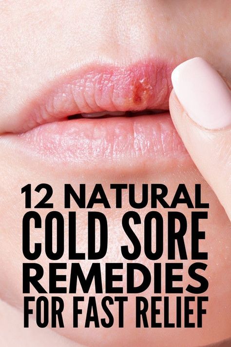 Cold Sore Remedies, Natural Cold Sore Remedy, Coconut Oil Face Mask, Fever Blister, Contour Makeup Tutorial, Cold Sores, Coconut Oil For Face, Cold Sores Remedies, Fall Makeup Looks