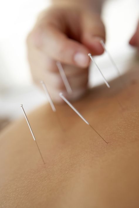 Practitioner applies acupuncture needles to a patient's shoulder. Acupuncture Benefits, Acupuncture Needles, Acupuncture Clinic, Integrative Health, Traditional Chinese Medicine, Chinese Medicine, Acupressure, Neck Pain, Alternative Medicine