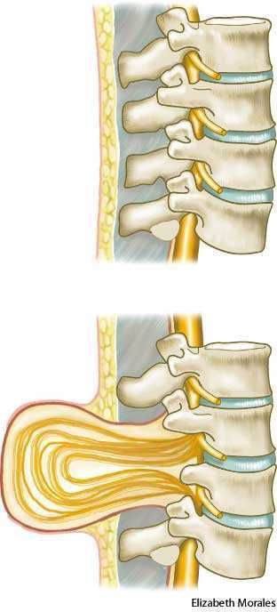 Spinal Column, Spina Bifida, Dictionary Definitions, Medical Anatomy, Neurological Disorders, Spinal Cord, Anatomy And Physiology, Folic Acid, Child Life