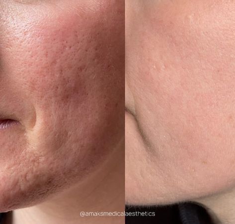 Pixel8-RF Microneedling + BioRePeel: The Ultimate Combination for Stunning Results🔥

At Amaks Aesthetics, we offered this powerful combination of Pixel8-RF Microneedling and BioRePeel to our client! 

This procedure uses a special attachment with micro-needles where high-frequen Biorepeel Aesthetic, Microneedling Aesthetic, Rf Microneedling, Spa, Quick Saves