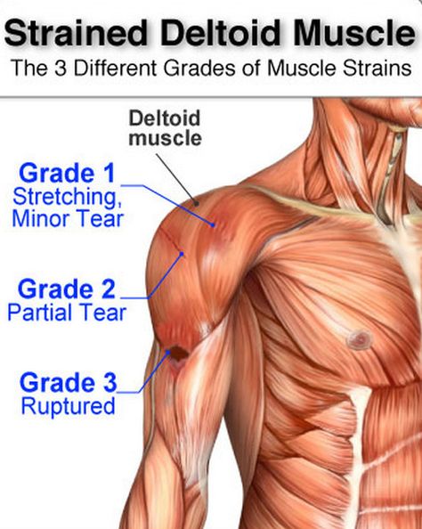 Human Biomechanics, Deltoid Muscle, Shoulder Muscle Pain, Shoulder Anatomy, Muscle Tear, Shoulder Muscle, Leg Muscle, Rotator Cuff Tear, Shoulder Injury