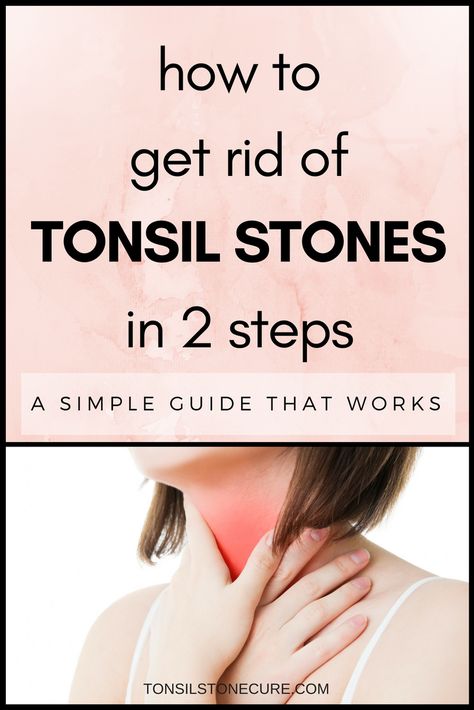 Getting rid of tonsil stones may seem like a difficult task, but it’s really not! If you're tired of dealing with tonsil stones, check out this simple, 2-step solution. Remedies For Swollen Tonsils, Tonsil Stone Removal, Swollen Tonsils, Baking Soda Benefits, Health Planner, Healthy Smile, Tooth Decay, Oral Hygiene, Dental Health