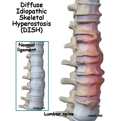 DISH Support Group on Facebook - Diffuse Idiopathic Skeletal Hyperostosis Yoga Information, Ligaments And Tendons, Patient Education, Skeletal, Chronic Pain, Back Pain, Disease, Bones, Medical