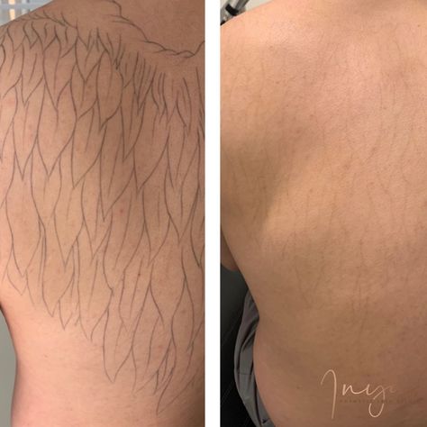 Laser Tattoo Removal Before And After, Microblading Studio, Time To Heal, Studio Tattoo, Laser Tattoo, Laser Tattoo Removal, Skin Clinic, After 3, Tattoo Removal