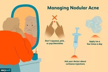 Nodule Acne, Nodular Acne, Inflamed Pimple, Back Acne Remedies, Blind Pimple, How To Help Nausea, Pimples Under The Skin, Pimples Overnight, Acne Vulgaris