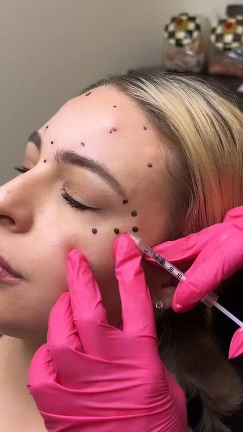 Botox Video, Botox For Headaches, Botox Eyes, Face Injections, Botox Injection Sites, Botox Facial, Facial Injections, Botox Lips, Botox Cosmetic