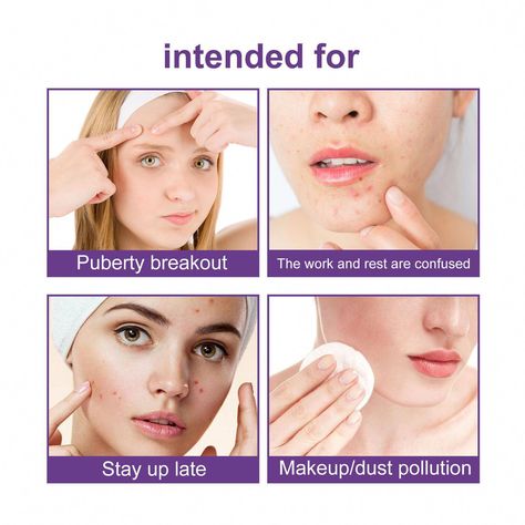 Feature: 1. Acne Elimination: These blemishes patches can help eliminate acne and reduce the risks of pimple outbreaks. Water Absorption: These acne patches contribute to absorb the water and reduce inflammation and blemishes. Pimple Remover Tool, Natural Remedies For Acne, Remedies For Acne, Acne Patch, Pimple Scars, Pimple Patch, Pimples On Face, Acne Gel, Natural Acne Remedies