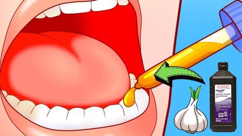 5 Ways To Relieve A Toothache In 1 Minute Infected Toothache Remedies, Tooth Ache Relief Remedies Diy, Homemade Tartar Sauce Easy, Toothache Remedies, Abscess Tooth, Tooth Pain Remedies, Severe Tooth Pain, Remedies For Dry Mouth, Tooth Pain Relief