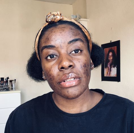 🔸Journey To Clear Skin🔸 Just a photo to show my skin concerns (active acne, hyperpigmentation and post inflammation and oily skin) Yikkes lol #skincare #hyperpigmentation #acne #oilyskin Embracing Acne, Skincare Hyperpigmentation, Acne Positivity, Hyperpigmentation Black Skin, Acne Women, Hair And Skin Vitamins, Human Skin Color, Braids Styling, Skin Vitamins