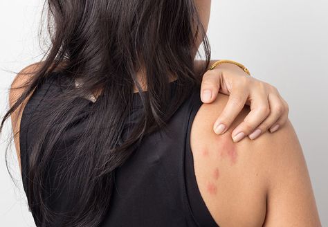 Hello, stress hives (yes, they're a thing). Here's what to do if you break out in itchy bumps at the worst possible time. Hives Causes, Chest Discomfort, Heart Muscle, Cleveland Clinic, Family Medicine, Heart Problems, Chest Pain, Stressful Situations, Break Out