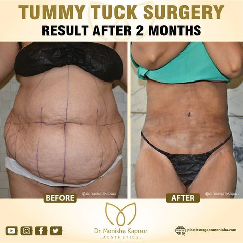 Monisha Kapoor makes all decisions based on safety and the best course of action to arrive at the desired result. After an abdominoplasty procedure is complete, sutures are used to close the incisions and drains may be placed to prevent swelling from excess fluid. 
#tummytuckbeforeandafter #beforeandafter #weightloss #weightlosstransformation #fitnessmotivation #goals #bodygoals #happy #happygirl #tummytucksurgery #plasticsurgery #tummytuckscar #tummytuckrecovery Tummy Tucks Before And After, Tummy Tucks Recovery, Surgery Doctor, Post Surgery, Smart Things, Best Fan, Tummy Tucks, Book An Appointment, Delhi India