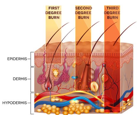 Home Remedies For Burns, Types Of Burns, Burn Remedy, Skin Anatomy, Burn Injury, Integumentary System, Degree Burns, Medical Pictures, Skin Burns