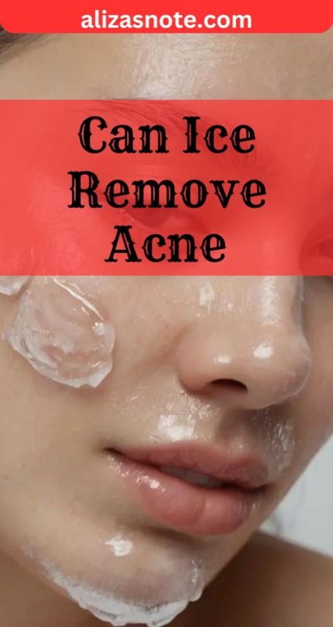 Can ice remove pimple #beauty #beautyhacks #pimple #acne, #pimples #overnightpimples #removepimples #removepimplesovernight https://whispers-in-the-wind.com/combatting-pimples-under-the-skin-expert-tips-and-product-recommendations/?175 Acne Removal Home Remedies, How To Remove Pimple Marks, How To Remove Acne Marks, Acne Marks Remedies, What Causes Pimples, Pimples On Scalp, Peroxide For Acne, Inflamed Pimple, Ice Therapy