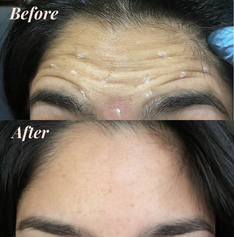 Before and After #Botox for the forehead IG: @boldbeautybar__ Forehead Botox Before And After, Forehead Botox Units, Botox For Frown Lines, Botox Before After, Botox Forehead Injection Sites, Botox Results, Botox Cost, Allergan Botox, Botox Before And After