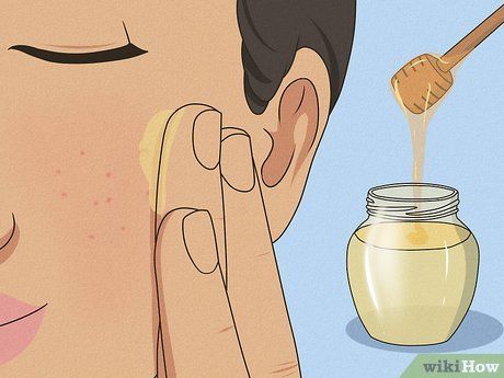 4 Ways to Get Rid of a Pimple with No Head - wikiHow Types Of Pimples On Face, Types Of Pimples, Neck Pimples, Pimples On Forehead, Home Remedies For Pimples, Blind Pimple, Clean Blackheads, Pimples On Face, How To Get Rid Of Pimples