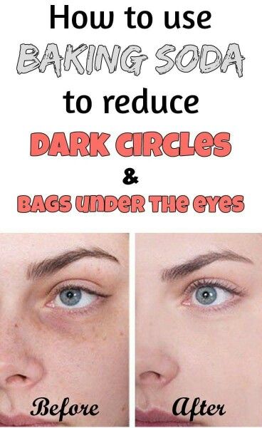 Baking Soda Under Eyes, Dark Circle Remedies, Baking Soda Face, Baking Soda Benefits, Baking Soda Uses, Baking Soda Shampoo, Under Eyes, Dark Circles Under Eyes, Reduce Dark Circles