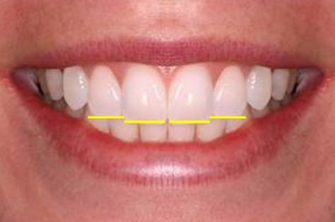 I want PERFECT TEETH! What is ideal? Ideal Smile Teeth, Teeth Shape Perfect, Best Veneers Teeth, Teeth Fangs Natural, Perfect Teeth Smile, Dental Braces Colors, Teeth Aesthetic, Pretty Teeth, Teeth Alignment