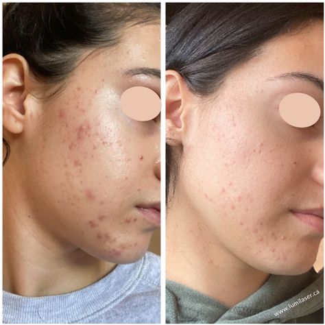 Before & After Photo Results Reviews at Lumilaser Esthetics – Montreal, Quebec, Canada Hydrafacial Before And After, Before And After Acne, Human Body Temperature, Acne Products, Skincare Acne, Acne Overnight, Perfect Nose, Acne Skincare, Beautiful Flowers Photography