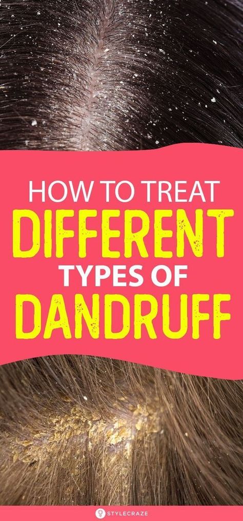 HOW TO TREAT DIFFERENT TYPES OF DANDRUFF AT HOME Bad Dandruff, Severe Dandruff, Dandruff Causes, Dandruff Solutions, Back Acne Remedies, Dandruff Flakes, Dandruff Remedy, Getting Rid Of Dandruff, Scrub Corpo