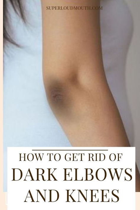 Home remedies to get rid of Dark Elbows and Knees Get Rid Of Dark Knees And Elbows, Remedy For Dark Knees, Lighten Dark Elbows, How To Get Rid Of Dark Knees And Elbows, Lighten Knees And Elbows, How To Get Rid Of Dark Spots On Knees, Rough Elbows How To Get Rid Of, Dark Knees And Elbows, Dark Elbows How To Get Rid Of