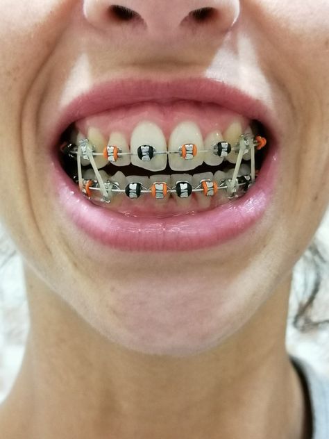 Halloween Braces, Braces On Teeth, Braces Rubber Bands, Orthodontic Appliances, Cute Braces, Teeth Braces, Ear Ring, Rubber Bands, Braces