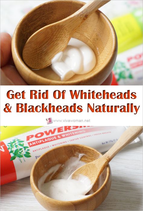 How to remove whiteheads and blackheads naturally. Whitehead Removal Diy, Diy Whitehead Removal, How To Treat White Heads On Face, White Heads On Chin, How To Get Rid Of Whiteheads, Remove White Heads From Face, How To Get Rid Of White Heads On Face, How To Remove White Heads From Face, White Heads Removal Remedies