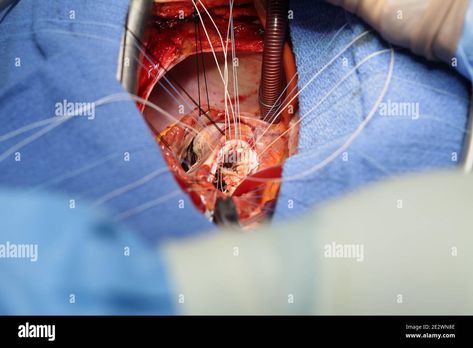 Download this stock image: Process of open heart surgery. - 2E2WN8E from Alamy's library of millions of high resolution stock photos, illustrations and vectors. Cheer Picture Poses, Open Heart Surgery, Heart Surgery, Cheer Pictures, Fairytale Dress, Image Processing, Open Heart, Biology, Surgery