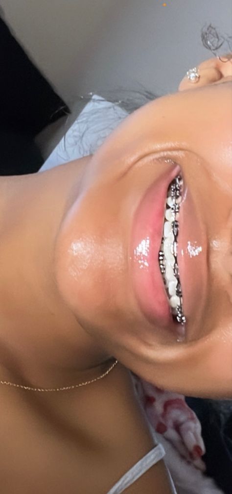 Pretty Teeth With Braces, Braces And Lipgloss, Briblixks Pics, Braces Colors Light Skin, Braces For Black Women, Braces Aesthetic Girl Black, Pink Braces Black Women, Braces Colors Black Women, Braces Manifestation