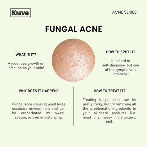 Fungal acne Products For Fungal Acne, Fungal Acne Skin Care Routine, How To Get Rid Of Fungal Acne, Treat Fungal Acne, Skin Knowledge, Fungal Acne Vs Bacterial Acne, Skin Fungus, Acne Toner, Fungal Acne