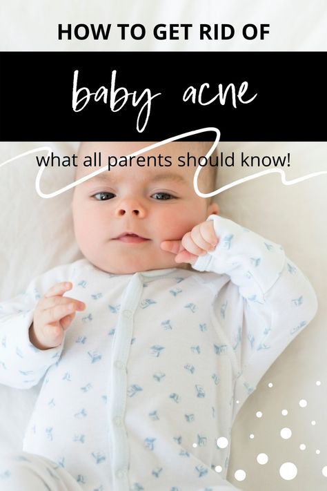 how to get rid of baby acne Baby Acne Remedy How To Get Rid Of, Baby Acne Remedy, Cold Remedies For Babies, Newborn Acne, Sick Baby Remedies, Cough And Cold Remedies, Postpartum Tips, Baby Remedies, Baby Acne