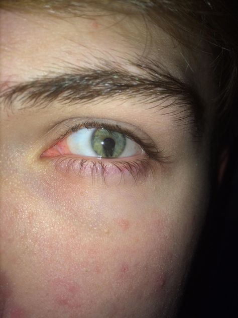 I have iris Coloboma in my left eye Coloboma Iris, Broken Iris Eye, Broken Iris, Iris Eye, Human Oddities, Left Eye, Aesthetic Design, Be Yourself, Eye Color