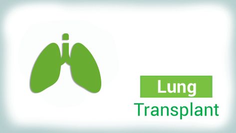 Lung transplant is a complex surgery, and adequate nutrition plays a vital role in the healing process | Foods to Avoid After Lung Transplant. Doctor Help, Lung Transplant, Healthy Lungs, The Healing Process, Help Digestion, Feeling Hungry, Foods To Avoid, Healthy Diet Plans, Proper Nutrition