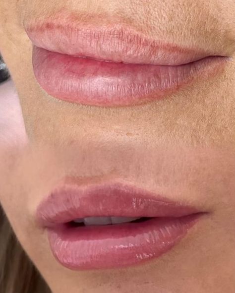 Before & After (healed) Lip Blush 🫦 How lush are these perfectly pink lips?! Just a bit of gloss and she is good to go! #LipBlush #GlowUp #GlossyLips #LipCare #PermanentMakeup #FlawlessResults #LipFiller #PerfectPout #LipGoals Lip Blush Tattoo Before And After, Healed Lip Blush, Lip Blushing Tattoo Colors, Cosmetic Treatments, Upper Lip, Lip Shapes, Cosmetic Procedures, Lip Fillers, Glossy Lips