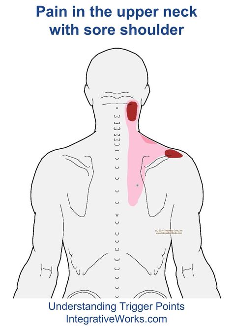 Understanding Trigger Points - Neck Pain with Sore Shoulder Shoulder Trigger Points, Trigger Points Neck, Shoulder Muscle Pain, Forward Head Posture Exercises, Sore Shoulder, Sore Neck, Back Pain Remedies, Stiff Neck, Upper Back Pain