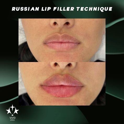 💋✨ Achieve perfectly defined, fuller lips with the Russian Lip Filler Technique at Vivid Clinic! This advanced technique creates beautifully shaped lips with more height and less volume for a natural, elegant pout. 💉 ✅ Focuses on lip height and shape ✅ Creates a subtle, natural-looking pout ✅ Long-lasting, stunning results 💬 Ready to enhance your lips? Book your free consultation today and experience the art of the Russian Lip Filler Technique at Vivid Clinic! 📍Located in Istanbul, Turkey ... Russian Lip Filler Technique, Russian Lips Filler, Lip Filler Technique, Russian Lip Filler, Lip Book, Russian Lips, Fuller Lips, Lip Filler, Lip Fillers