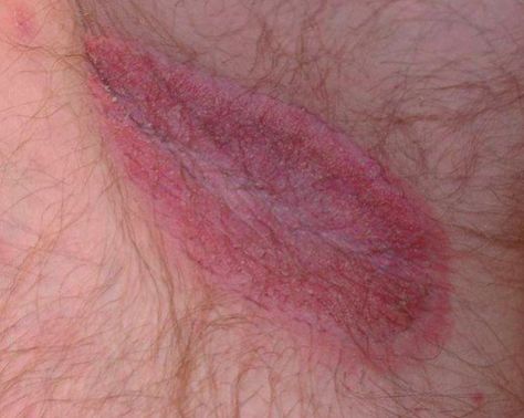 Groin Rash, Home Remedies For Rashes, Yeast Infection On Skin, Home Remedies For Face, Fungal Rash, Armpit Rash, Rashes Remedies, Heat Rash, Get Rid Of Warts