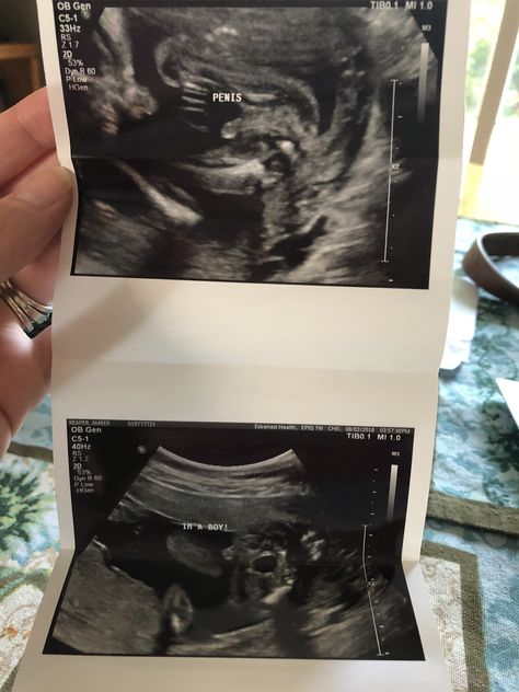 Ultrasound photos of our baby boy. Hunter James Stanfield, due to arrive on Christmas Day 2018. Boy Ultrasound Pictures, Boy Ultrasound, Baby Ultrasound, Ultrasound Pictures, Happily Married, Ultrasound, Love Forever, Married Life, Christmas Day