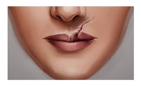 Scar On Face Sketch, Mouth Scar Reference Drawing, Lip Scars Reference, How To Draw Freckles, How To Draw Scars, Facial Scars, Cleft Lip, Lip Drawing, Stretch Mark Removal