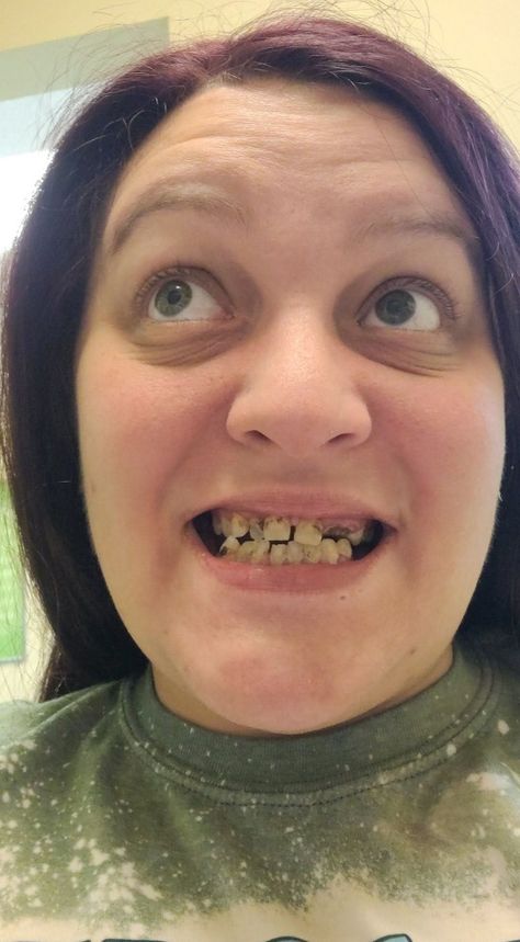 A MUM has revealed how she was forced to wear DENTURES by the time she hit 31. Dakila Mccombs, 32, shared how her teeth started to fall out when she was just 22 after having her braces removed. The mum-of-two spent the next decade feeling insecure about her smile and her teeth, as the serious […] Teeth Makeover, No Teeth, Crooked Teeth, Bad Teeth, Fake Teeth, Gummy Smile, Front Teeth, Bring Me Down, Smile Teeth