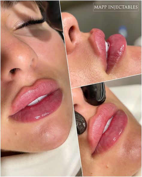 Sydney lip injections Russian Lips Aesthetic, Perfect Lips Injections, Lips Fillers Shapes, Lips Injections Shapes, Russian Lips Filler Before And After, Lip Injections Shapes, Lip Filler Shapes, Pouty Lip Filler, Lip Fillers Shapes