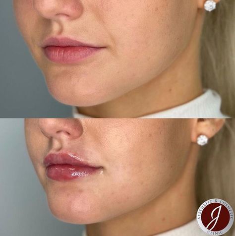 Upper Lip Filler, Light Lip Filler, Natural Lip Fillers 0.5ml, Natural Looking Lip Fillers, Pouty Lip Filler, 0.5ml Lip Filler Before And After, Lip Filler Natural, Remove Upper Lip Hair Naturally, Natural Lip Fillers