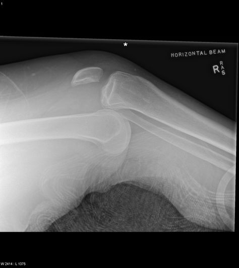 Case courtesy of Dr Craig Hacking, <a href="https://radiopaedia.org/">Radiopaedia.org</a>. From the case <a href="https://radiopaedia.org/cases/48246">rID: 48246</a> Knee Xray, Dislocated Knee, Radiographic Positioning, Radiographic Anatomy, Radiology Schools, Rad Tech Week, Radiology Student, Radiology Technologist, Tech Week