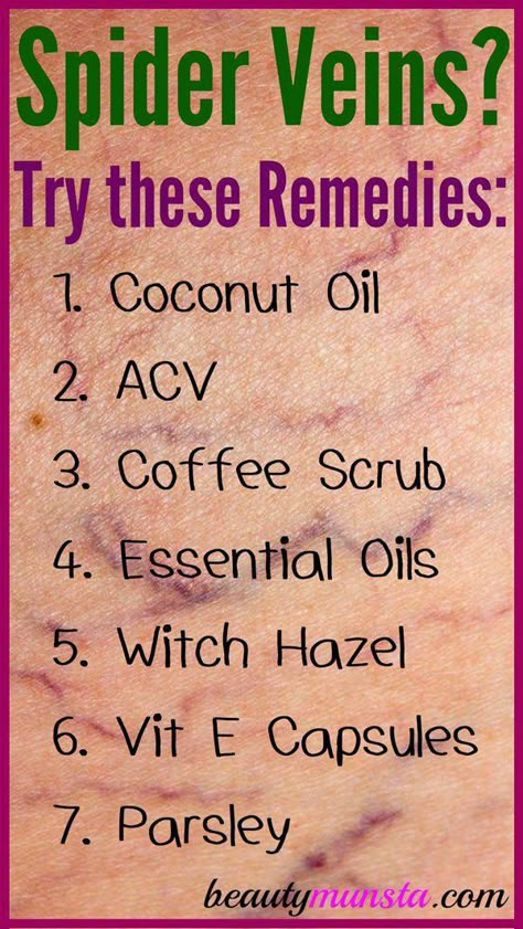 Varicose Vein Remedy, Natural Healing Remedies, Diy Remedies, Natural Therapy, Natural Health Remedies, Natural Beauty Tips, Natural Home Remedies, Health Remedies, Natural Healing