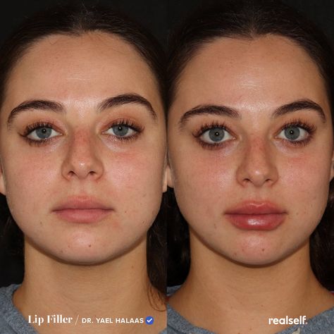 Lower Lip Filler, 0.5 Lip Filler Before And After, .5 Lip Filler, Lip Filler On Small Lips, 0.5ml Lip Filler Before And After, Subtle Lip Filler Before And After, 0.5 Ml Lip Filler Before And After, Before And After Lip Fillers, Lip Filler Before And After