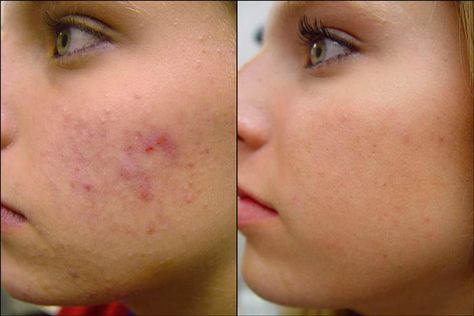 Cheek Acne, Acne Facial, Scar Removal, Cystic Acne, Acne Remedies, How To Get Rid Of Acne, Prevent Acne, Pharmacology, Anti Acne