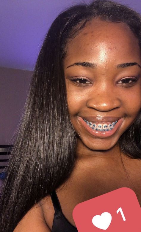 Black Girls With Braces, Dark Blue Braces, Light Blue Braces, Braces Journey, Dental Braces Colors, Braces Colors Combinations, Blue Braces, Braces Cute, Braces Black