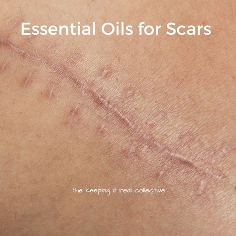 Scarring Remedies, Face Scars Removal, Get Rid Of Scars, How To Get Rid Of Scars, Scar Removal Diy, Natural Scar Remedies, Essential Oils For Keloids, How To Fade Scars, Essential Oils For Healing After Surgery